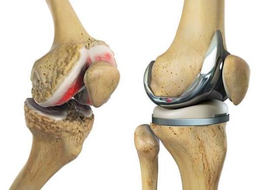 The Intricacies of Total Knee Arthroplasty: Navigating the Gaps Between Tradition and Innovation
